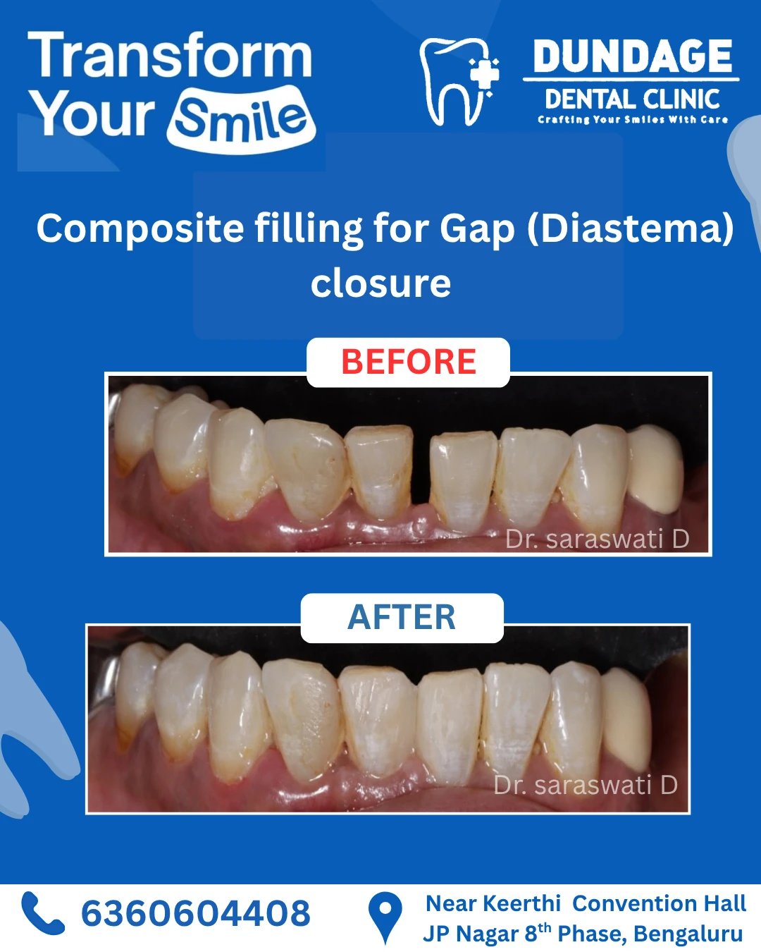 Clinic poster showing before and after views of composite filling for a gap between front teeth