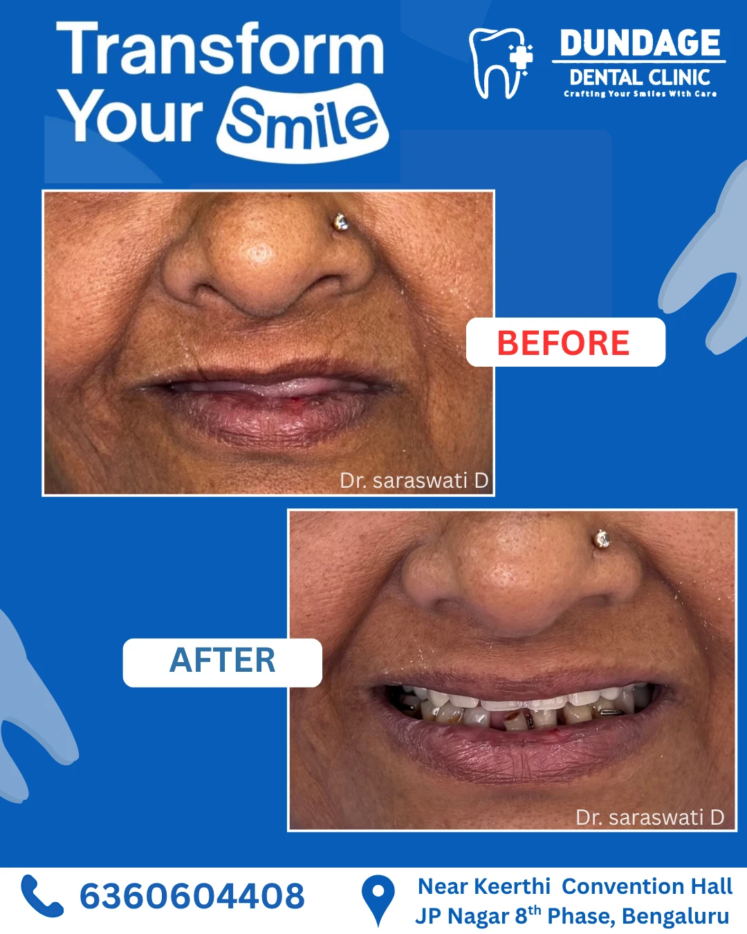 Clinic poster with before and after close-up views of a patient’s lower face and smile